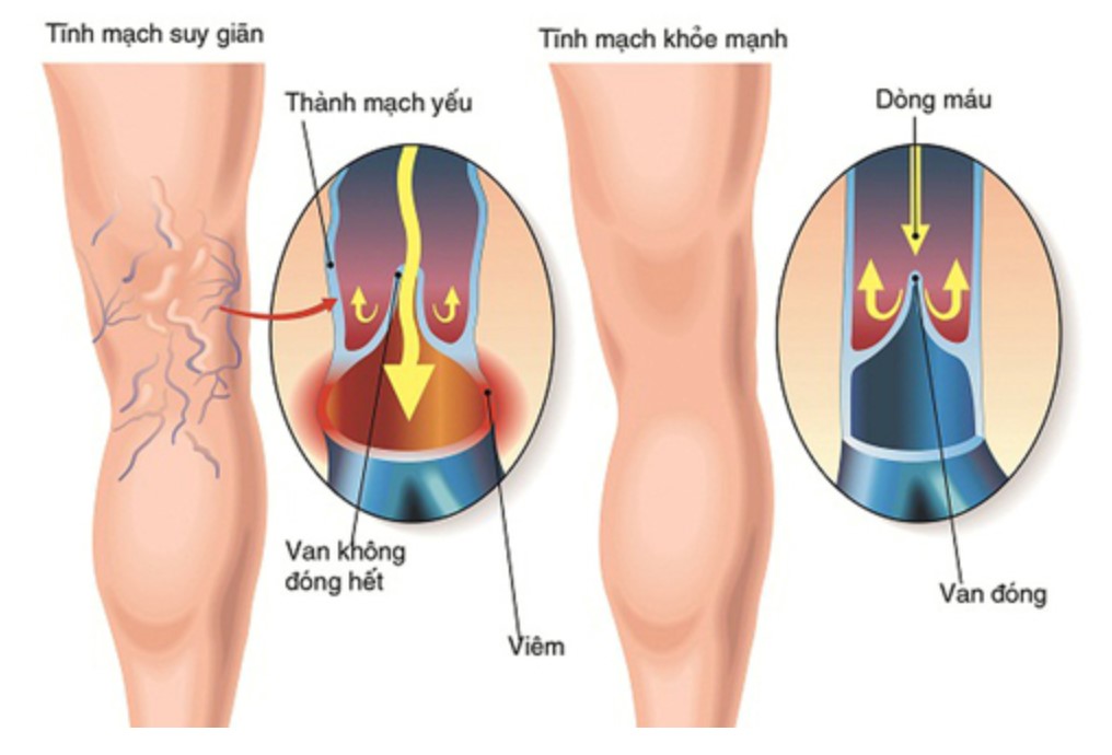 Suy giãn tĩnh mạch chi ở phụ nữ-  Những điều cần biết